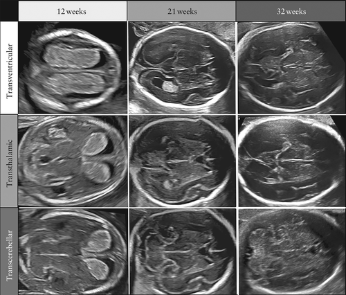 胎儿mt是什么检查什么疼吗ISUOG胎儿中枢神经系统超声检查指南（2020）第一部分：筛查及针对性神经超声检查的适应症_https://www.jmylbn.com_新闻资讯_第2张