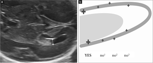 胎儿mt是什么检查什么疼吗ISUOG胎儿中枢神经系统超声检查指南（2020）第一部分：筛查及针对性神经超声检查的适应症_https://www.jmylbn.com_新闻资讯_第6张