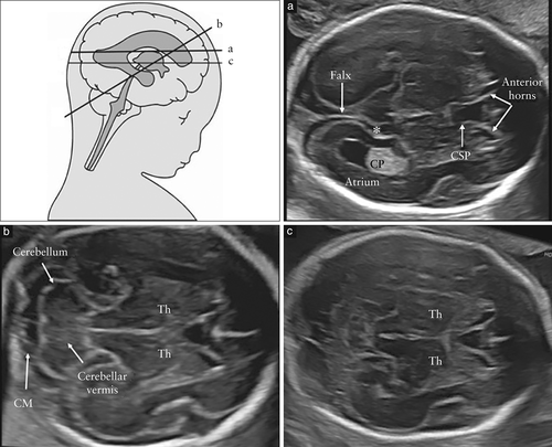 胎儿mt是什么检查什么疼吗ISUOG胎儿中枢神经系统超声检查指南（2020）第一部分：筛查及针对性神经超声检查的适应症_https://www.jmylbn.com_新闻资讯_第3张