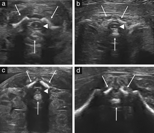 胎儿mt是什么检查什么疼吗ISUOG胎儿中枢神经系统超声检查指南（2020）第一部分：筛查及针对性神经超声检查的适应症_https://www.jmylbn.com_新闻资讯_第5张