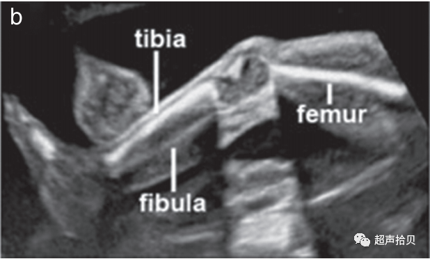 胎儿mt是什么检查什么疼吗【文献学习】【规范、指南】ISUOG实践指南：中孕期胎儿常规超声检查（2022更新）_https://www.jmylbn.com_新闻资讯_第23张