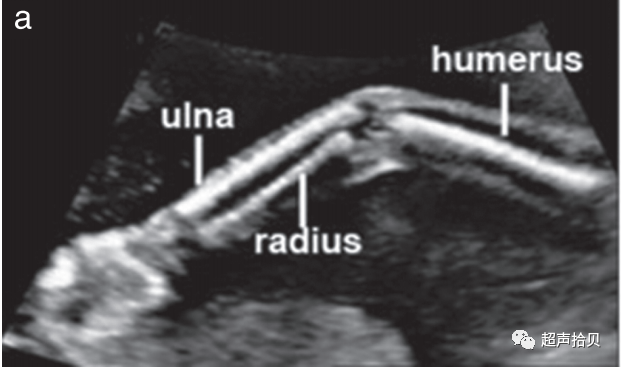 胎儿mt是什么检查什么疼吗【文献学习】【规范、指南】ISUOG实践指南：中孕期胎儿常规超声检查（2022更新）_https://www.jmylbn.com_新闻资讯_第22张