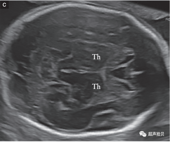 胎儿mt是什么检查什么疼吗【文献学习】【规范、指南】ISUOG实践指南：中孕期胎儿常规超声检查（2022更新）_https://www.jmylbn.com_新闻资讯_第9张