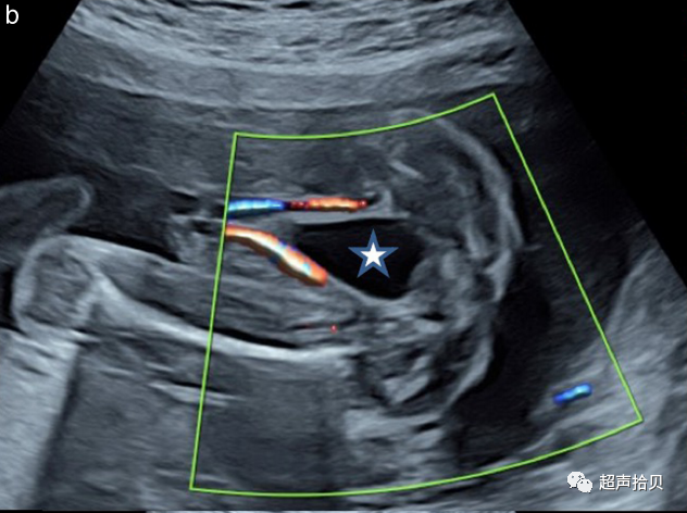胎儿mt是什么检查什么疼吗【文献学习】【规范、指南】ISUOG实践指南：中孕期胎儿常规超声检查（2022更新）_https://www.jmylbn.com_新闻资讯_第19张