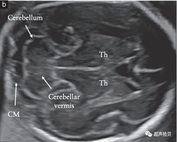 胎儿mt是什么检查什么疼吗【文献学习】【规范、指南】ISUOG实践指南：中孕期胎儿常规超声检查（2022更新）_https://www.jmylbn.com_新闻资讯_第8张