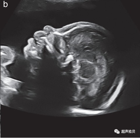 胎儿mt是什么检查什么疼吗【文献学习】【规范、指南】ISUOG实践指南：中孕期胎儿常规超声检查（2022更新）_https://www.jmylbn.com_新闻资讯_第11张