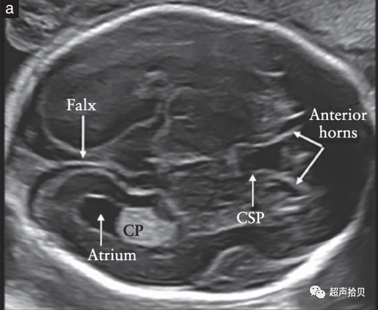 胎儿mt是什么检查什么疼吗【文献学习】【规范、指南】ISUOG实践指南：中孕期胎儿常规超声检查（2022更新）_https://www.jmylbn.com_新闻资讯_第7张