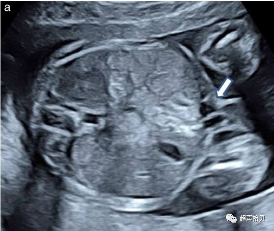 胎儿mt是什么检查什么疼吗【文献学习】【规范、指南】ISUOG实践指南：中孕期胎儿常规超声检查（2022更新）_https://www.jmylbn.com_新闻资讯_第18张