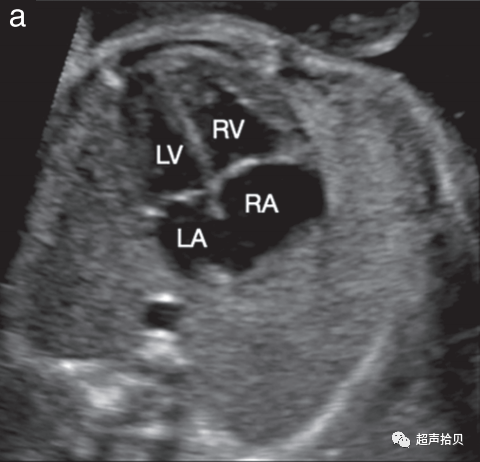 胎儿mt是什么检查什么疼吗【文献学习】【规范、指南】ISUOG实践指南：中孕期胎儿常规超声检查（2022更新）_https://www.jmylbn.com_新闻资讯_第13张