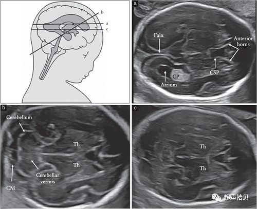 胎儿mt是什么检查什么疼吗【文献学习】【规范、指南】ISUOG实践指南：中孕期胎儿常规超声检查（2022更新）_https://www.jmylbn.com_新闻资讯_第5张