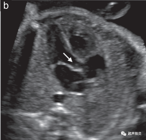 胎儿mt是什么检查什么疼吗【文献学习】【规范、指南】ISUOG实践指南：中孕期胎儿常规超声检查（2022更新）_https://www.jmylbn.com_新闻资讯_第14张