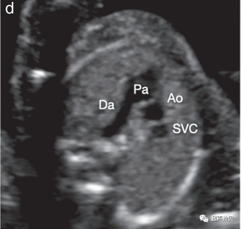 胎儿mt是什么检查什么疼吗【文献学习】【规范、指南】ISUOG实践指南：中孕期胎儿常规超声检查（2022更新）_https://www.jmylbn.com_新闻资讯_第16张