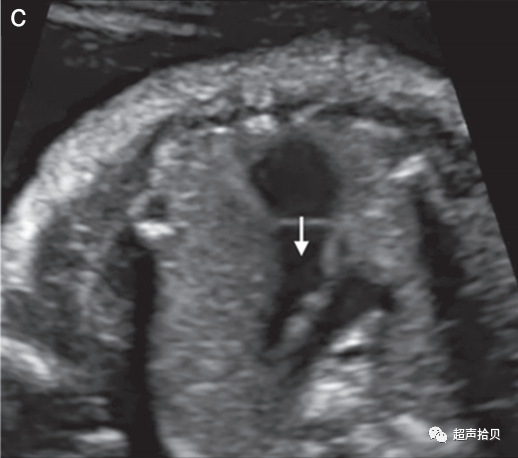 胎儿mt是什么检查什么疼吗【文献学习】【规范、指南】ISUOG实践指南：中孕期胎儿常规超声检查（2022更新）_https://www.jmylbn.com_新闻资讯_第15张