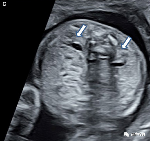 胎儿mt是什么检查什么疼吗【文献学习】【规范、指南】ISUOG实践指南：中孕期胎儿常规超声检查（2022更新）_https://www.jmylbn.com_新闻资讯_第20张