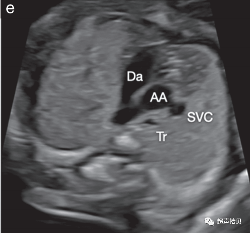 胎儿mt是什么检查什么疼吗【文献学习】【规范、指南】ISUOG实践指南：中孕期胎儿常规超声检查（2022更新）_https://www.jmylbn.com_新闻资讯_第17张