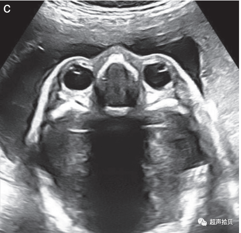 胎儿mt是什么检查什么疼吗【文献学习】【规范、指南】ISUOG实践指南：中孕期胎儿常规超声检查（2022更新）_https://www.jmylbn.com_新闻资讯_第12张