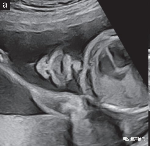 胎儿mt是什么检查什么疼吗【文献学习】【规范、指南】ISUOG实践指南：中孕期胎儿常规超声检查（2022更新）_https://www.jmylbn.com_新闻资讯_第10张