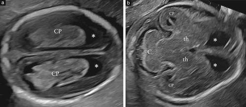 胎儿mt是什么检查什么疼吗ISUOG胎儿中枢神经系统超声检查指南（2020）第一部分：筛查及针对性神经超声检查的适应症_https://www.jmylbn.com_新闻资讯_第7张