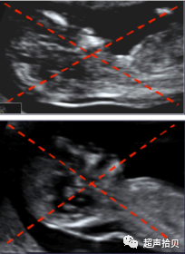 胎儿mt是什么检查什么疼吗【专题讲座】11-13周的超声检查（3）-染色体异常筛查-颈项透明层、胎儿心率_https://www.jmylbn.com_新闻资讯_第4张