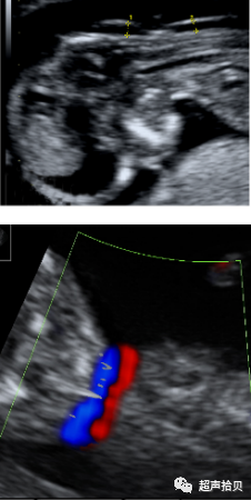 胎儿mt是什么检查什么疼吗【专题讲座】11-13周的超声检查（3）-染色体异常筛查-颈项透明层、胎儿心率_https://www.jmylbn.com_新闻资讯_第6张