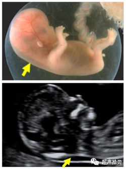 胎儿mt是什么检查什么疼吗【专题讲座】11-13周的超声检查（3）-染色体异常筛查-颈项透明层、胎儿心率_https://www.jmylbn.com_新闻资讯_第2张