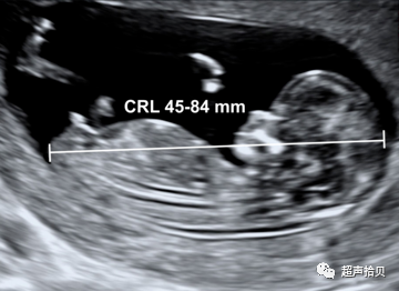 胎儿mt是什么检查什么疼吗【专题讲座】11-13周的超声检查（3）-染色体异常筛查-颈项透明层、胎儿心率_https://www.jmylbn.com_新闻资讯_第3张