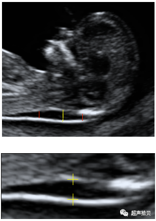 胎儿mt是什么检查什么疼吗【专题讲座】11-13周的超声检查（3）-染色体异常筛查-颈项透明层、胎儿心率_https://www.jmylbn.com_新闻资讯_第5张