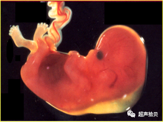 胎儿mt是什么检查什么疼吗【早孕专题】11-13周胎儿超声检查：胎儿染色体异常筛查 IV -NT增厚的管理_https://www.jmylbn.com_新闻资讯_第2张