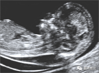 胎儿mt是什么检查什么疼吗【早孕专题】11-13周胎儿超声检查：胎儿染色体异常筛查 IV -NT增厚的管理_https://www.jmylbn.com_新闻资讯_第6张