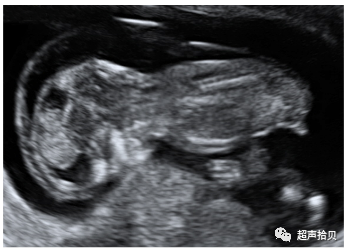 胎儿mt是什么检查什么疼吗【早孕专题】11-13周胎儿超声检查：胎儿染色体异常筛查 IV -NT增厚的管理_https://www.jmylbn.com_新闻资讯_第10张