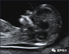 胎儿mt是什么检查什么疼吗【早孕专题】11-13周胎儿超声检查：胎儿染色体异常筛查 IV -NT增厚的管理_https://www.jmylbn.com_新闻资讯_第8张