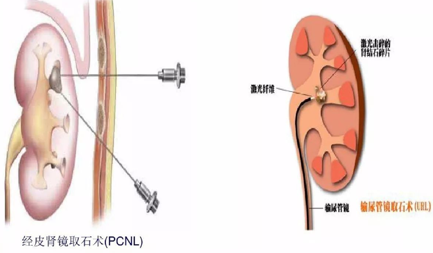 table 1 classifications of pcnl