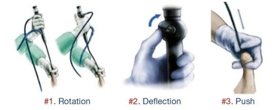 输尿管鞘是什么输尿管软镜碎石术_https://www.jmylbn.com_新闻资讯_第9张