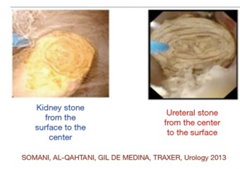 输尿管鞘是什么输尿管软镜碎石术_https://www.jmylbn.com_新闻资讯_第3张