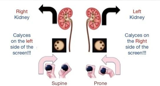 输尿管鞘是什么输尿管软镜碎石术_https://www.jmylbn.com_新闻资讯_第10张