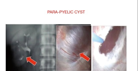 输尿管鞘是什么输尿管软镜碎石术_https://www.jmylbn.com_新闻资讯_第17张