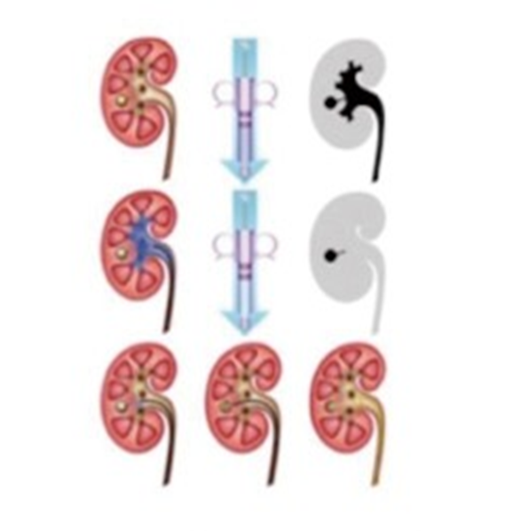 输尿管鞘是什么输尿管软镜碎石术_https://www.jmylbn.com_新闻资讯_第18张