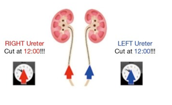 输尿管鞘是什么输尿管软镜碎石术_https://www.jmylbn.com_新闻资讯_第20张
