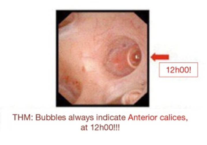输尿管鞘是什么输尿管软镜碎石术_https://www.jmylbn.com_新闻资讯_第13张