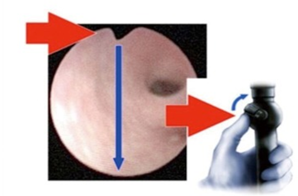 输尿管鞘是什么输尿管软镜碎石术_https://www.jmylbn.com_新闻资讯_第12张