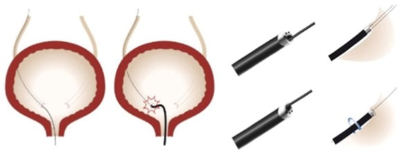 输尿管鞘是什么输尿管软镜碎石术_https://www.jmylbn.com_新闻资讯_第7张