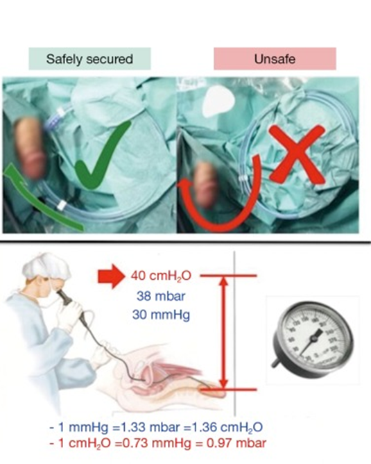 输尿管鞘是什么输尿管软镜碎石术_https://www.jmylbn.com_新闻资讯_第6张
