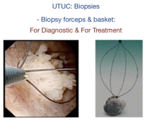 输尿管鞘是什么输尿管软镜碎石术_https://www.jmylbn.com_新闻资讯_第15张