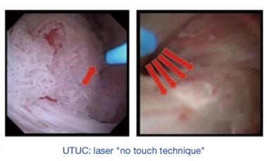 输尿管鞘是什么输尿管软镜碎石术_https://www.jmylbn.com_新闻资讯_第16张