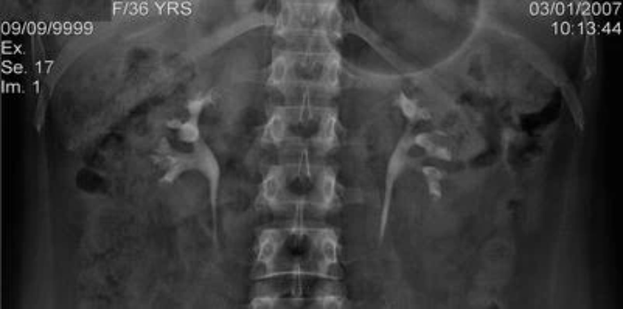 取石球囊怎么取石经皮肾镜取石术的要点_https://www.jmylbn.com_新闻资讯_第2张