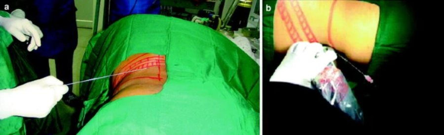 取石球囊怎么取石经皮肾镜取石术的要点_https://www.jmylbn.com_新闻资讯_第5张