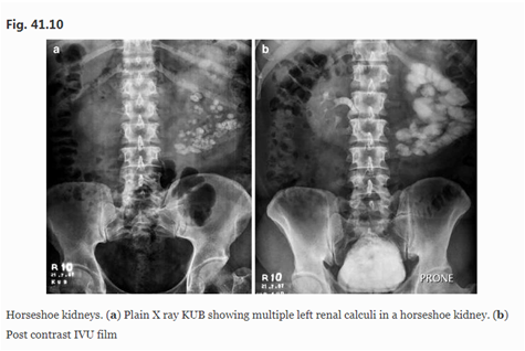 取石球囊怎么取石经皮肾镜取石术的要点_https://www.jmylbn.com_新闻资讯_第11张