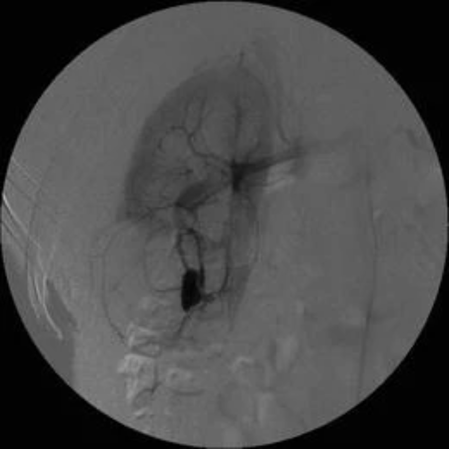 取石球囊怎么取石经皮肾镜取石术的要点_https://www.jmylbn.com_新闻资讯_第9张