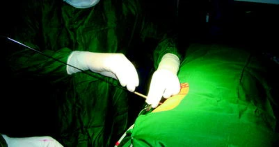 取石球囊怎么取石经皮肾镜取石术的要点_https://www.jmylbn.com_新闻资讯_第6张