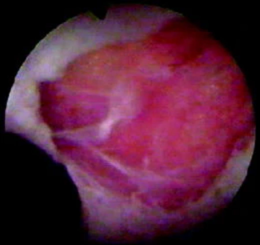 取石球囊怎么取石经皮肾镜取石术的要点_https://www.jmylbn.com_新闻资讯_第10张